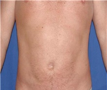 Liposuction After Photo by Karol Gutowski, MD, FACS; Glenview, IL - Case 39223