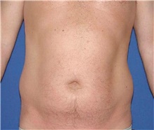 Liposuction Before Photo by Karol Gutowski, MD, FACS; Glenview, IL - Case 39223