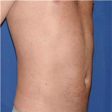 Liposuction After Photo by Karol Gutowski, MD, FACS; Glenview, IL - Case 39223