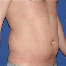 Liposuction Before Photo by Karol Gutowski, MD, FACS; Glenview, IL - Case 39223