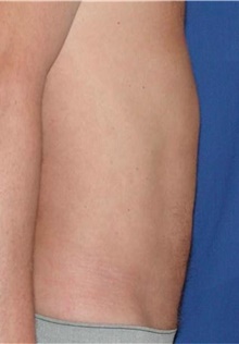 Liposuction After Photo by Karol Gutowski, MD, FACS; Glenview, IL - Case 39223