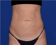 Liposuction After Photo by Karol Gutowski, MD, FACS; Glenview, IL - Case 39224