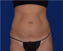 Liposuction Before Photo by Karol Gutowski, MD, FACS; Glenview, IL - Case 39224