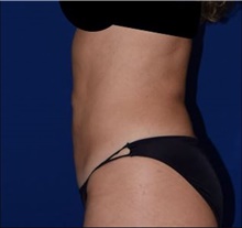 Liposuction After Photo by Karol Gutowski, MD, FACS; Glenview, IL - Case 39224