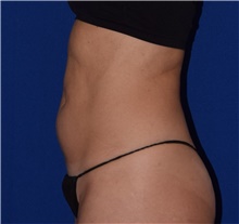 Liposuction Before Photo by Karol Gutowski, MD, FACS; Glenview, IL - Case 39224