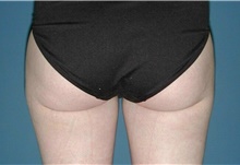 Liposuction After Photo by Karol Gutowski, MD, FACS; Glenview, IL - Case 39225