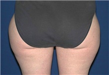 Liposuction Before Photo by Karol Gutowski, MD, FACS; Glenview, IL - Case 39225