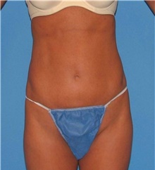 Liposuction After Photo by Karol Gutowski, MD, FACS; Glenview, IL - Case 39226