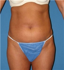 Liposuction Before Photo by Karol Gutowski, MD, FACS; Glenview, IL - Case 39226