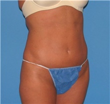 Liposuction After Photo by Karol Gutowski, MD, FACS; Glenview, IL - Case 39226