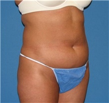 Liposuction Before Photo by Karol Gutowski, MD, FACS; Glenview, IL - Case 39226