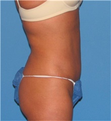 Liposuction After Photo by Karol Gutowski, MD, FACS; Glenview, IL - Case 39226