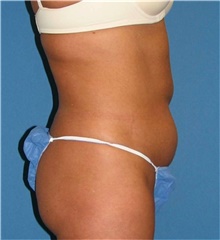 Liposuction Before Photo by Karol Gutowski, MD, FACS; Glenview, IL - Case 39226