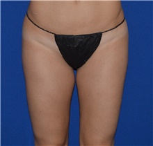 Liposuction Before Photo by Karol Gutowski, MD, FACS; Glenview, IL - Case 39230