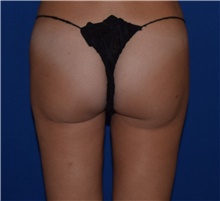 Liposuction After Photo by Karol Gutowski, MD, FACS; Glenview, IL - Case 39230