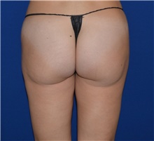 Liposuction Before Photo by Karol Gutowski, MD, FACS; Glenview, IL - Case 39230