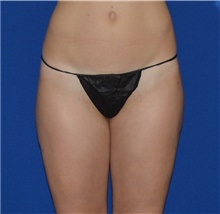 Liposuction After Photo by Karol Gutowski, MD, FACS; Glenview, IL - Case 39231