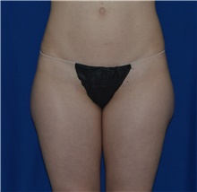 Liposuction Before Photo by Karol Gutowski, MD, FACS; Glenview, IL - Case 39231