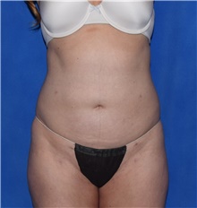 Liposuction After Photo by Karol Gutowski, MD, FACS; Glenview, IL - Case 39235