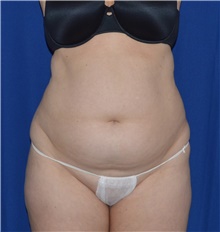 Liposuction Before Photo by Karol Gutowski, MD, FACS; Glenview, IL - Case 39235