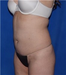 Liposuction After Photo by Karol Gutowski, MD, FACS; Glenview, IL - Case 39235