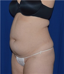 Liposuction Before Photo by Karol Gutowski, MD, FACS; Glenview, IL - Case 39235