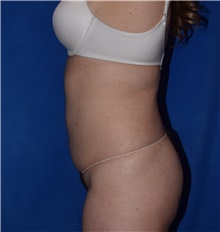 Liposuction After Photo by Karol Gutowski, MD, FACS; Glenview, IL - Case 39235