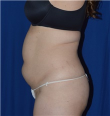 Liposuction Before Photo by Karol Gutowski, MD, FACS; Glenview, IL - Case 39235