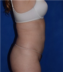 Liposuction After Photo by Karol Gutowski, MD, FACS; Glenview, IL - Case 39235