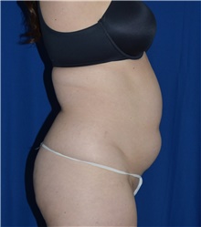 Liposuction Before Photo by Karol Gutowski, MD, FACS; Glenview, IL - Case 39235