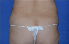 Liposuction Before Photo by Karol Gutowski, MD, FACS; Glenview, IL - Case 39236