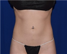 Liposuction After Photo by Karol Gutowski, MD, FACS; Glenview, IL - Case 39239