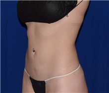 Liposuction After Photo by Karol Gutowski, MD, FACS; Glenview, IL - Case 39239