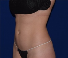 Liposuction Before Photo by Karol Gutowski, MD, FACS; Glenview, IL - Case 39239