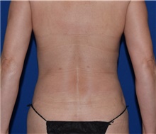 Liposuction After Photo by Karol Gutowski, MD, FACS; Glenview, IL - Case 39240