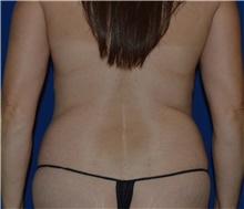 Liposuction Before Photo by Karol Gutowski, MD, FACS; Glenview, IL - Case 39240