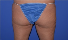 Liposuction After Photo by Karol Gutowski, MD, FACS; Glenview, IL - Case 39241