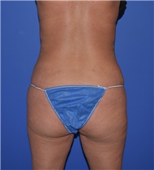 Liposuction After Photo by Karol Gutowski, MD, FACS; Glenview, IL - Case 39242