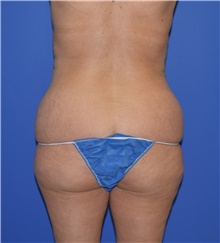 Liposuction Before Photo by Karol Gutowski, MD, FACS; Glenview, IL - Case 39242