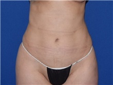 Liposuction After Photo by Karol Gutowski, MD, FACS; Glenview, IL - Case 39243