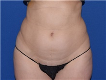 Liposuction Before Photo by Karol Gutowski, MD, FACS; Glenview, IL - Case 39243