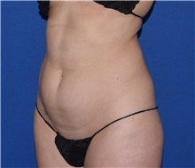 Liposuction Before Photo by Karol Gutowski, MD, FACS; Glenview, IL - Case 39243