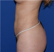 Liposuction After Photo by Karol Gutowski, MD, FACS; Glenview, IL - Case 39243