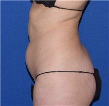 Liposuction Before Photo by Karol Gutowski, MD, FACS; Glenview, IL - Case 39243