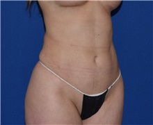 Liposuction After Photo by Karol Gutowski, MD, FACS; Glenview, IL - Case 39243