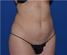 Liposuction Before Photo by Karol Gutowski, MD, FACS; Glenview, IL - Case 39243