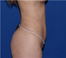 Liposuction After Photo by Karol Gutowski, MD, FACS; Glenview, IL - Case 39243