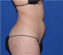 Liposuction Before Photo by Karol Gutowski, MD, FACS; Glenview, IL - Case 39243