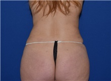 Liposuction After Photo by Karol Gutowski, MD, FACS; Glenview, IL - Case 39243