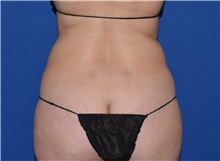 Liposuction Before Photo by Karol Gutowski, MD, FACS; Glenview, IL - Case 39243